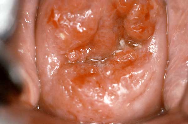 low grade cervical carcinoma