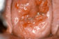 low grade cervical carcinoma