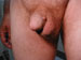 Penile Condyloma Acuminata